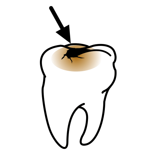 Pictograma de caries para niños con autismo y TEA