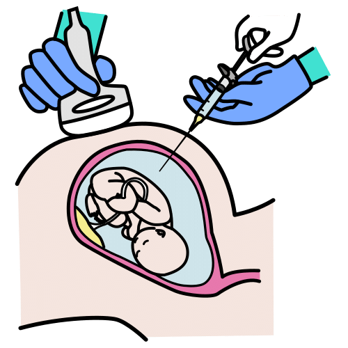 Pictograma de amniocentesis para niños con TEA