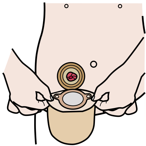 Pictograma de colocar bolsa de ostomía para niños con TEA